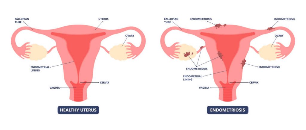 endometriosis